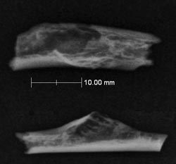 Detailed analysis revealed the tell-tale signs of a bone tumour.